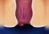 How to STOP Your Hemorrhoids from Growing - Expert Tips by Dr. Raviram S