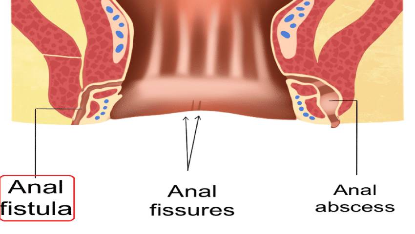 Anal Abscess and Fistula Treatment in Thrissur at Thrissur Piles Clinic by Dr. Raviram S.