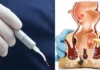 Laser Piles Surgery vs Conventional Surgery – Best Piles Treatment in Thrissur, Kerala by Dr. Raviram S.