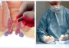 Laser vs Traditional Surgery comparison for piles, fistula, and fissure treatment in Thrissur