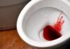 Baby blood in stool treatment in Thrissur by Dr. Raviram S. at Thrissur Piles Clinic