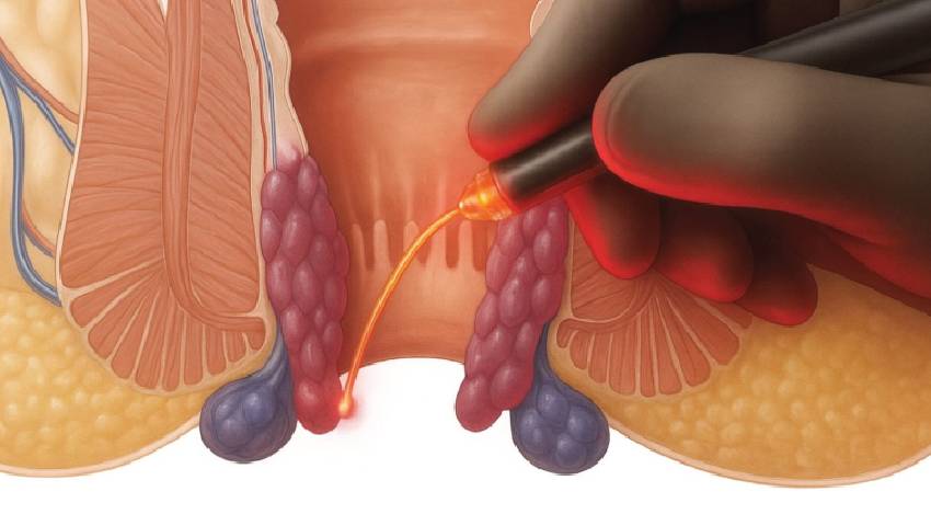 can piles come back after laser surgery real recurrence rates and prevention tips laser piles treatment Kerala Thrissur