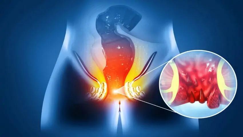 fistula vs pilonidal sinus symptoms differences and treatment options explained