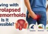 Patient suffering from prolapsed hemorrhoids consulting Dr. Raviram S for advanced laser piles treatment in Thrissur
