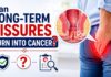 Can long-term anal fissures turn into cancer? Expert guidance from Dr. Raviram S.